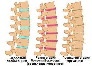 Инверсионный стол при болезни бехтерева