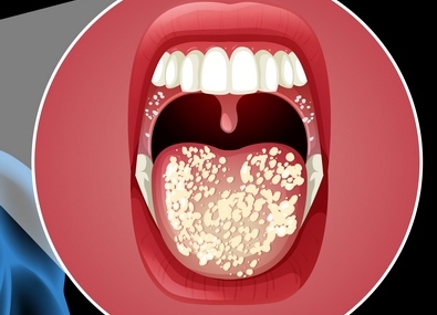 Лечение рака ротовой полости рта в Израиле.